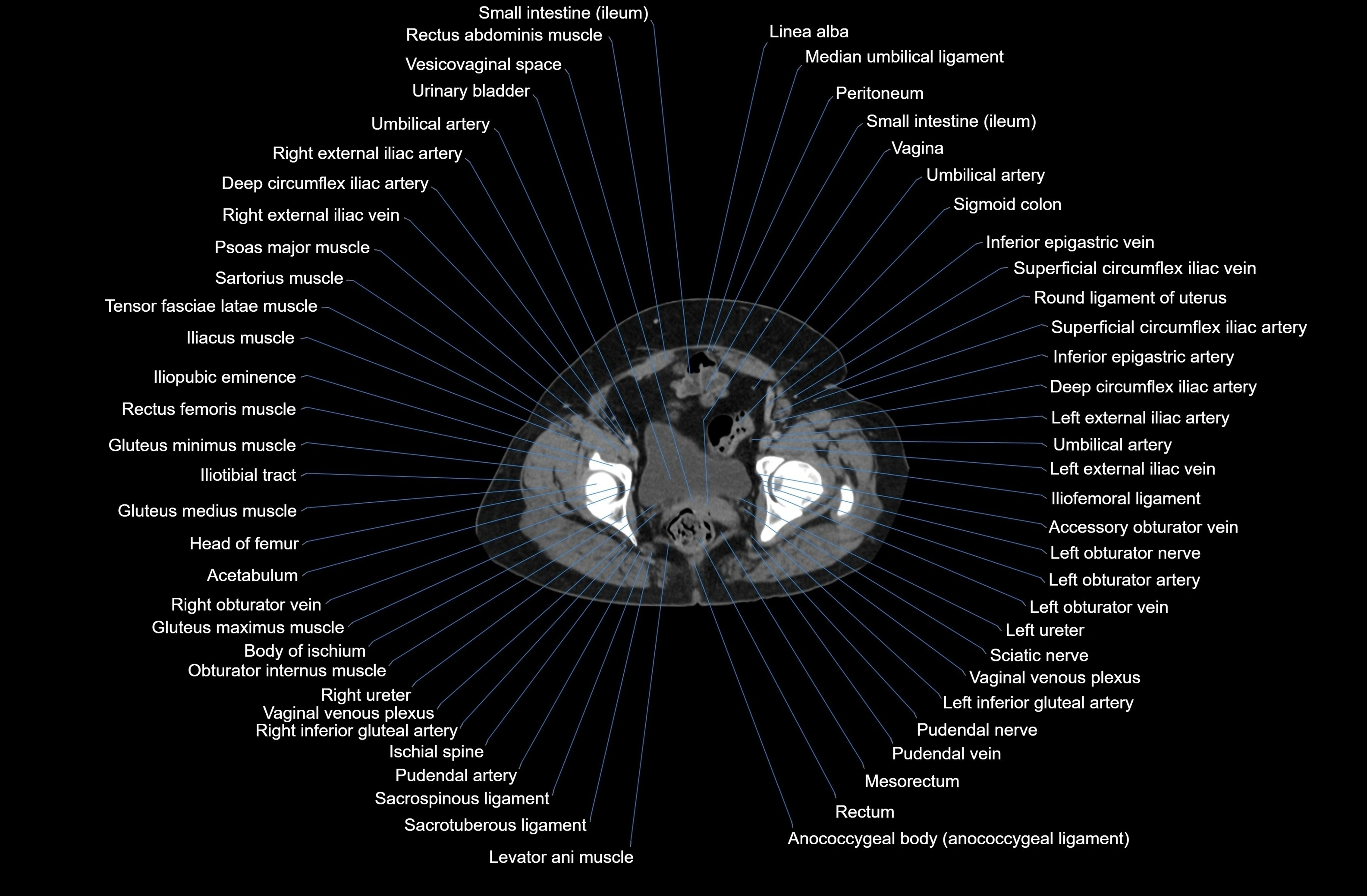 CT Abdomen axial cross sectional anatomy labelled radiology image-00090.webp